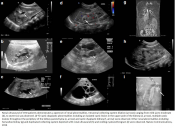 Genetic link between renal birth defects and congenital heart disease