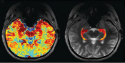 New neuroimaging method better identifies epileptic lesions