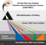 Subtypes of rare childhood brain tumor identified