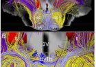 Sub-cortical connections critical to human consciousness identified!