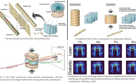 Type 2 diabetes alters the behavior of discs in the vertebral column