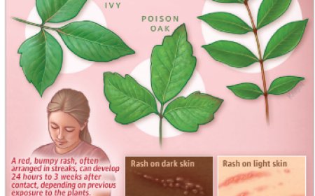 Poison Ivy, Poison Oak, and Poison Sumac