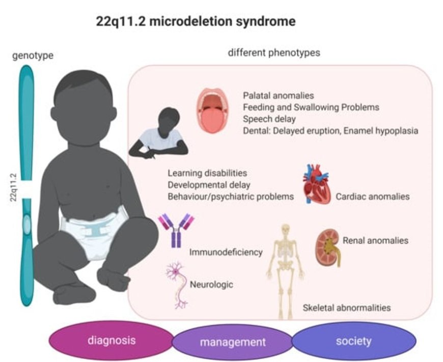 Chromosomal 22q11.2 deletion confers risk for severe spina bifida