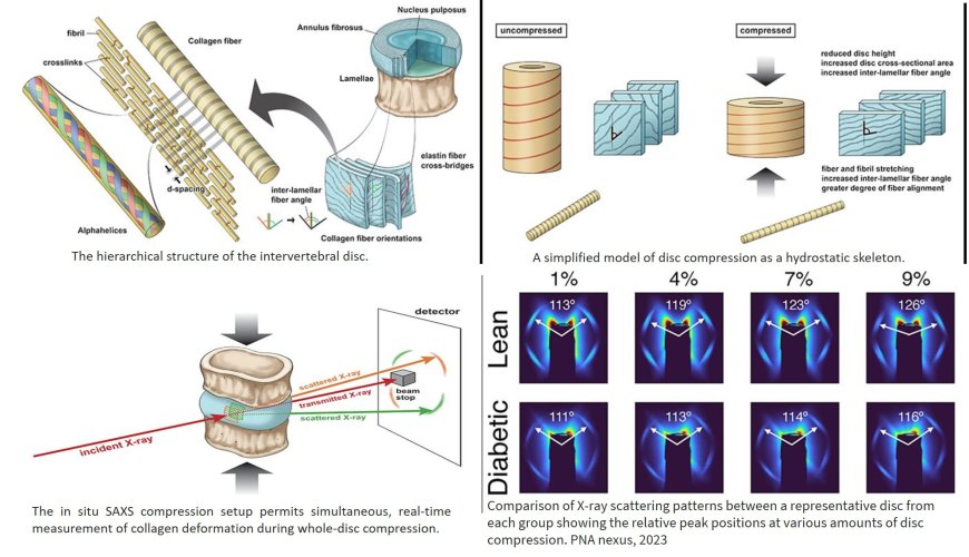 Type 2 diabetes alters the behavior of discs in the vertebral column