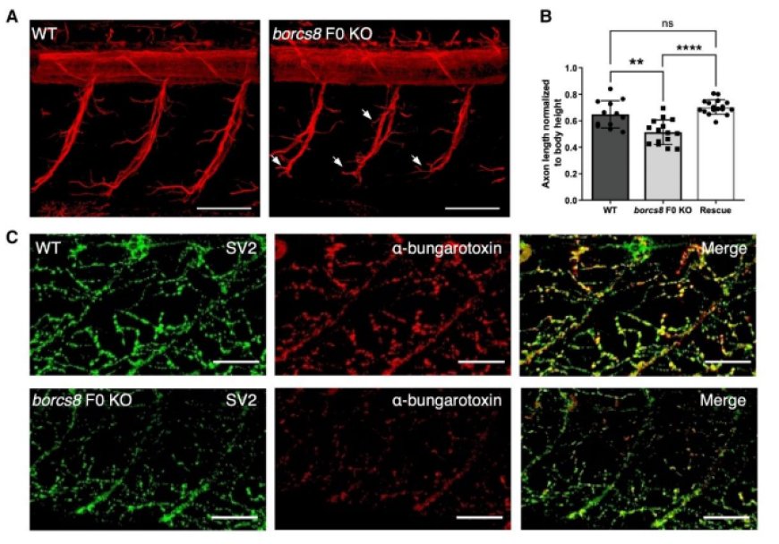 Biallelic BORCS8 variants cause an infantile-onset neurodegenerative disorder with altered lysosome dynamics