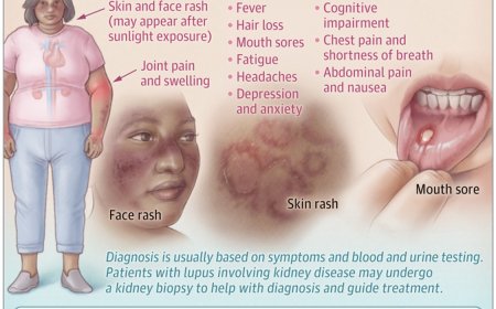 What Is Lupus?