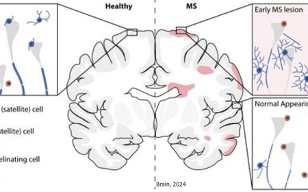 Remyelination in multiple sclerosis!