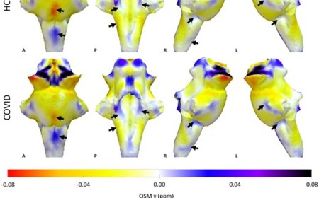 Damage to brain’s ‘control center’ is behind long-lasting Covid-19 symptoms