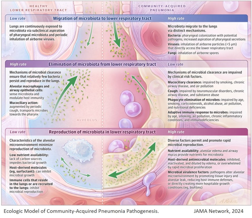 Community-Acquired Pneumonia