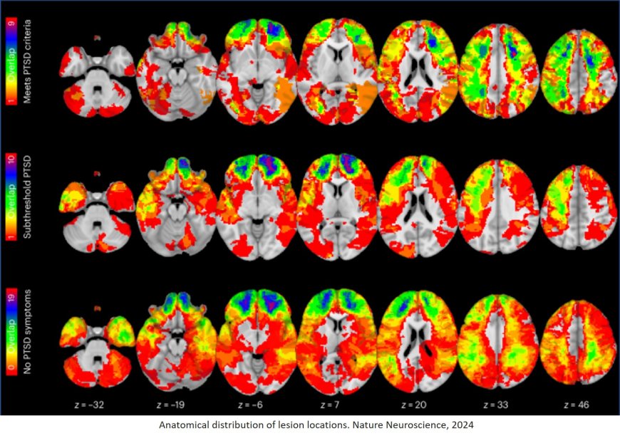 Common brain network detected among veterans with PTSD