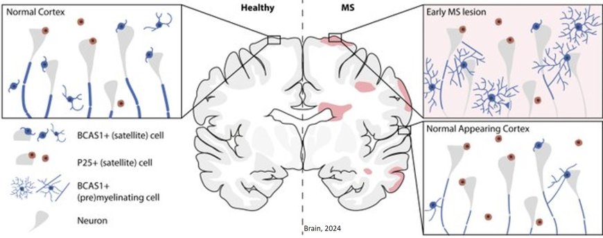 BCAS1-positive oligodendrocytes enable efficient cortical remyelination in multiple sclerosis