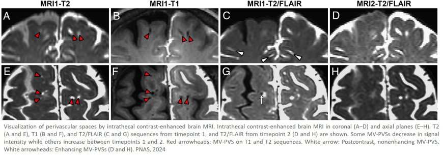 The perivascular space is a conduit for cerebrospinal fluid flow in humans: A proof-of-principle report