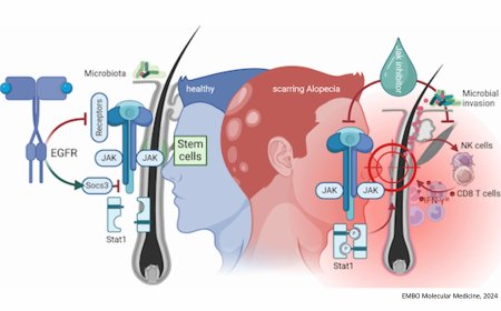 Targeting EGFR deficiency-associated inflammation and scarring alopecia