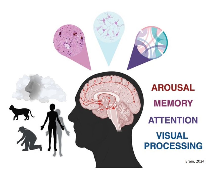 Visual hallucinations in Parkinson's disease: spotlight on 3 central cholinergic dysfunction