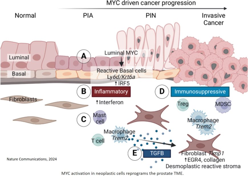 A common culprit drives prostate cancer progression