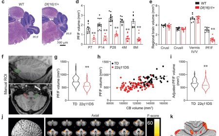Linking genetic risk for schizophrenia to a malformed skull