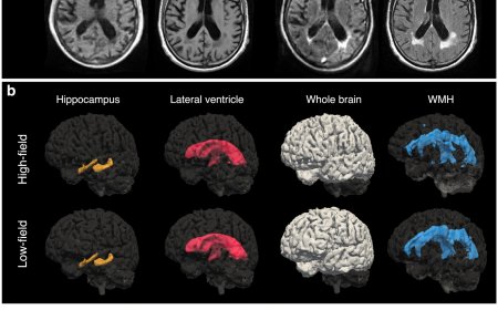 Portable, low-field MRI for Alzheimer’s disease imaging