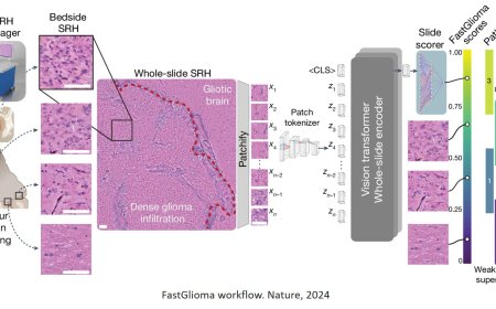 An AI model detects cancerous brain tumor often missed during surgery