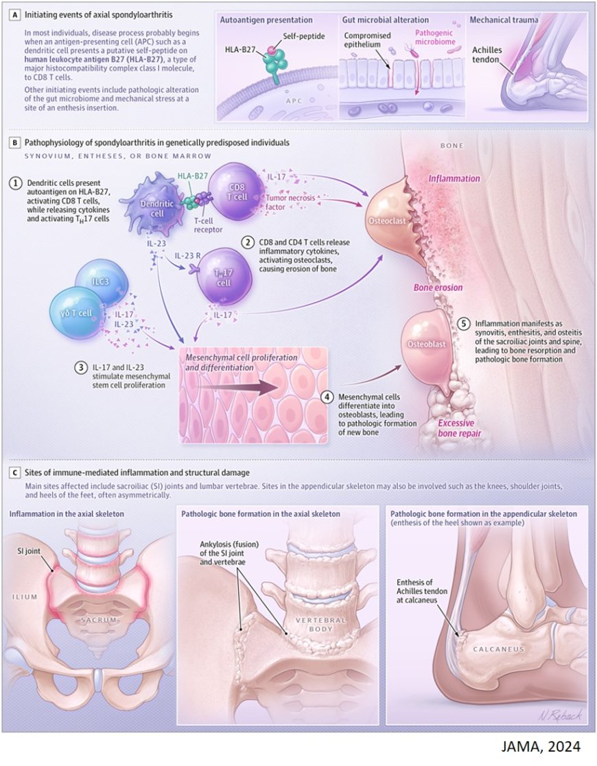 Axial Spondyloarthritis