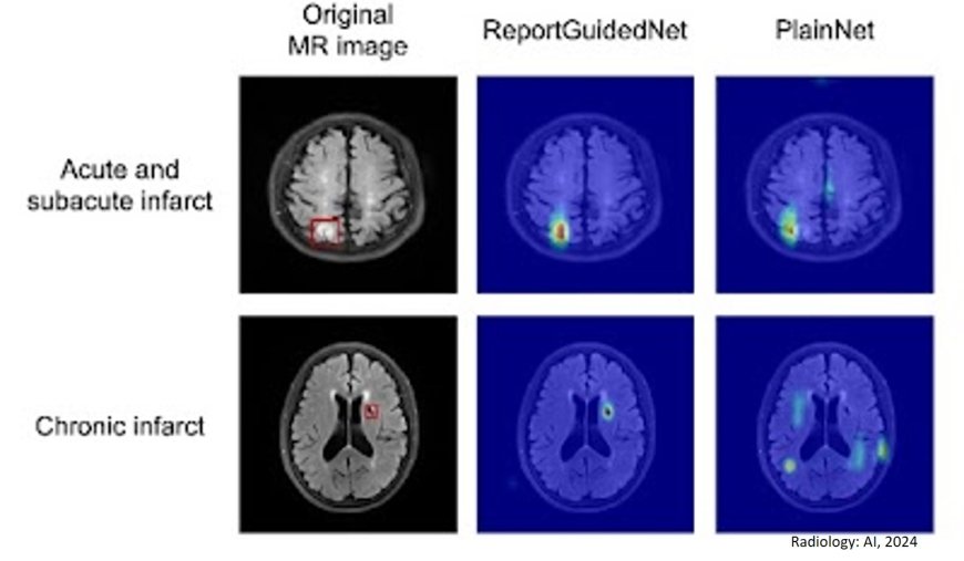 Improving AI model for interpretable brain MRI lesion detection