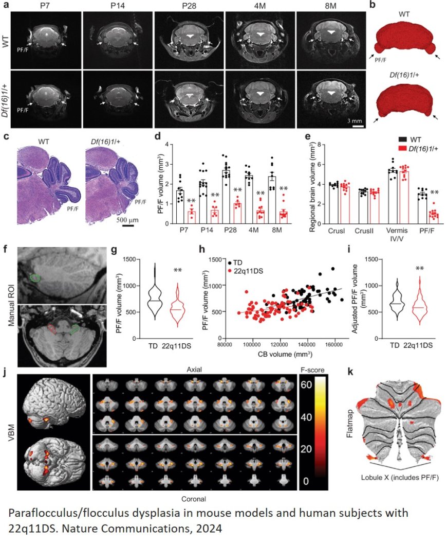 Linking genetic risk for schizophrenia to a malformed skull