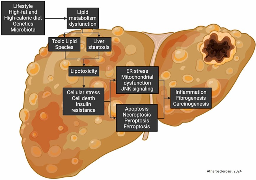 Lipotoxicity-driven metabolic dysfunction-associated steatotic liver disease (MASLD)