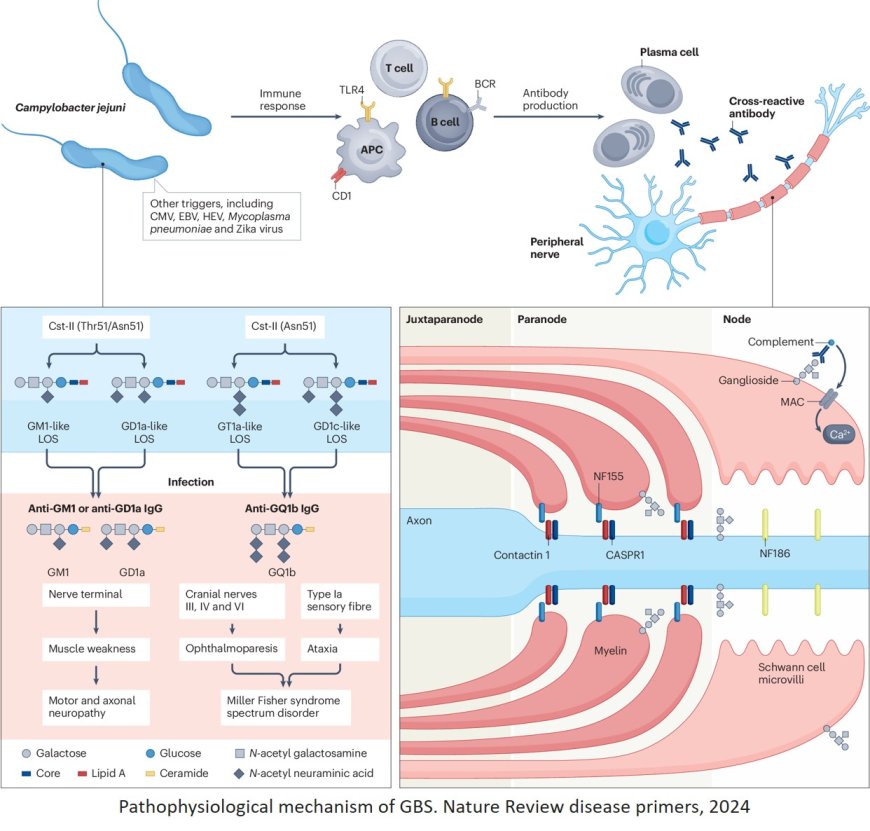 Guillain–Barré syndrome