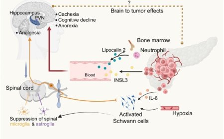 Neuropathic changes in pancreatic cancer