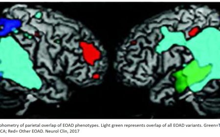 Early-Onset Alzheimer’s Disease: What Is Missing in Research?