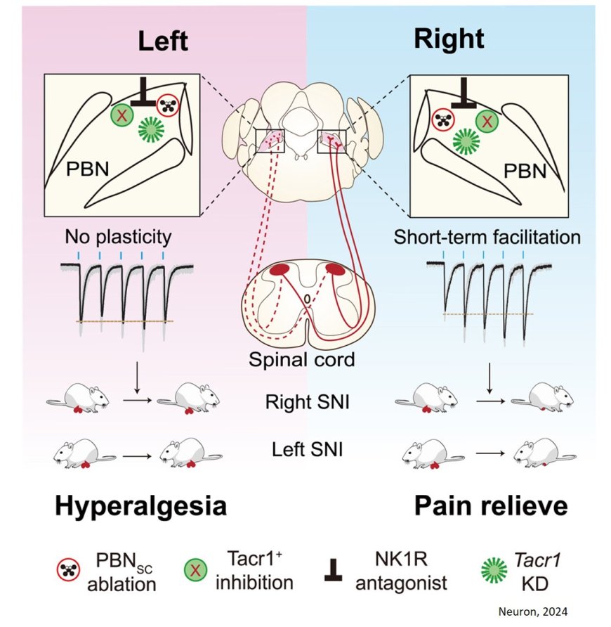 Right parabrachial nucleus mediates early-phase neuropathic pain development