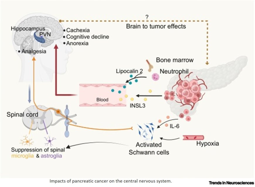 Neuropathic changes in pancreatic cancer