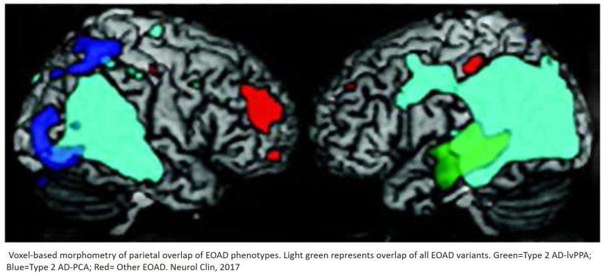 Early-Onset Alzheimer’s Disease: What Is Missing in Research?