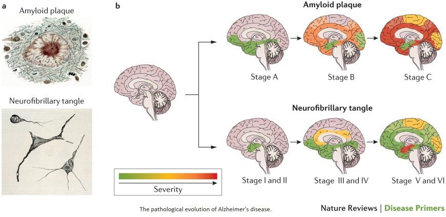 Alzheimer’s disease