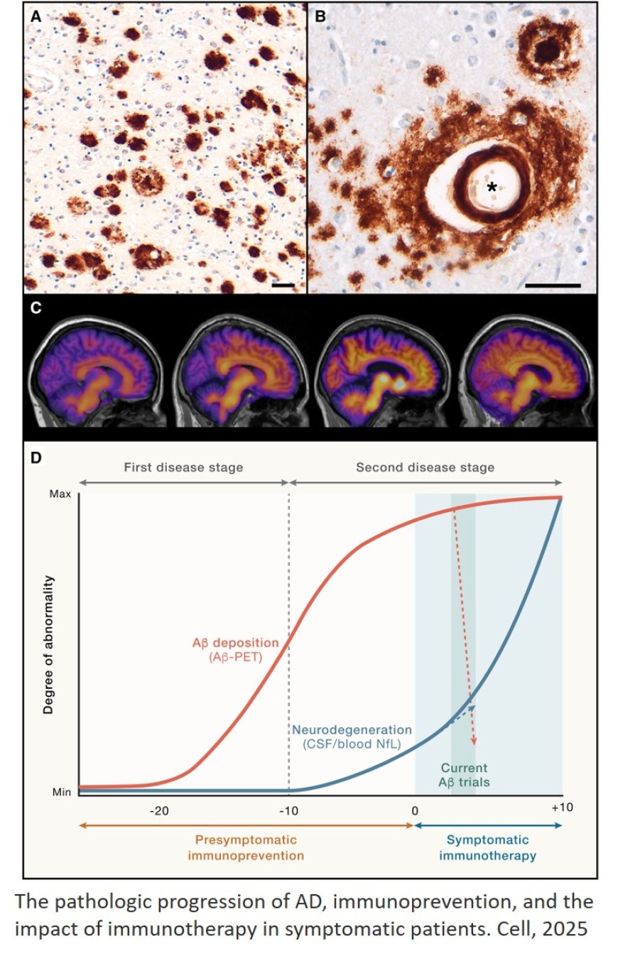 Alzheimer’s disease: From immunotherapy to immunoprevention