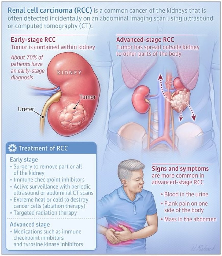 What Is Renal Cell Carcinoma?