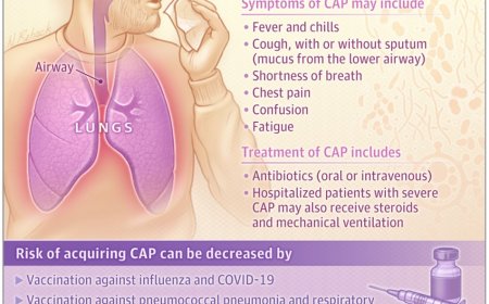 What Is Community-Acquired Pneumonia?