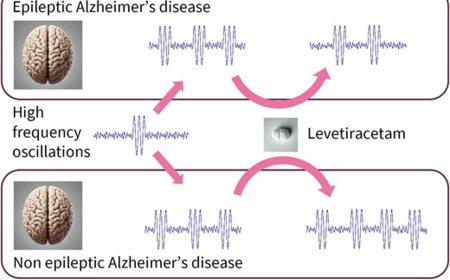 Brain rhythms can predict seizure risk of Alzheimer’s disease patients