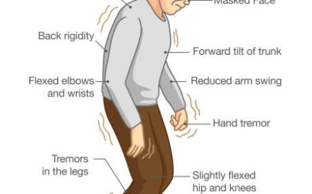 Parkinson’s Disease