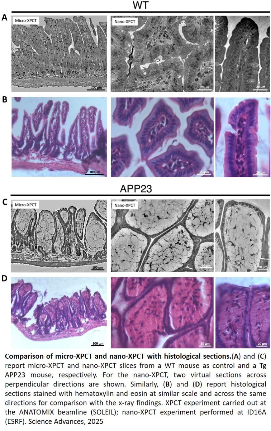 The gut-brain connection in Alzheimer’s unveiled with X-rays