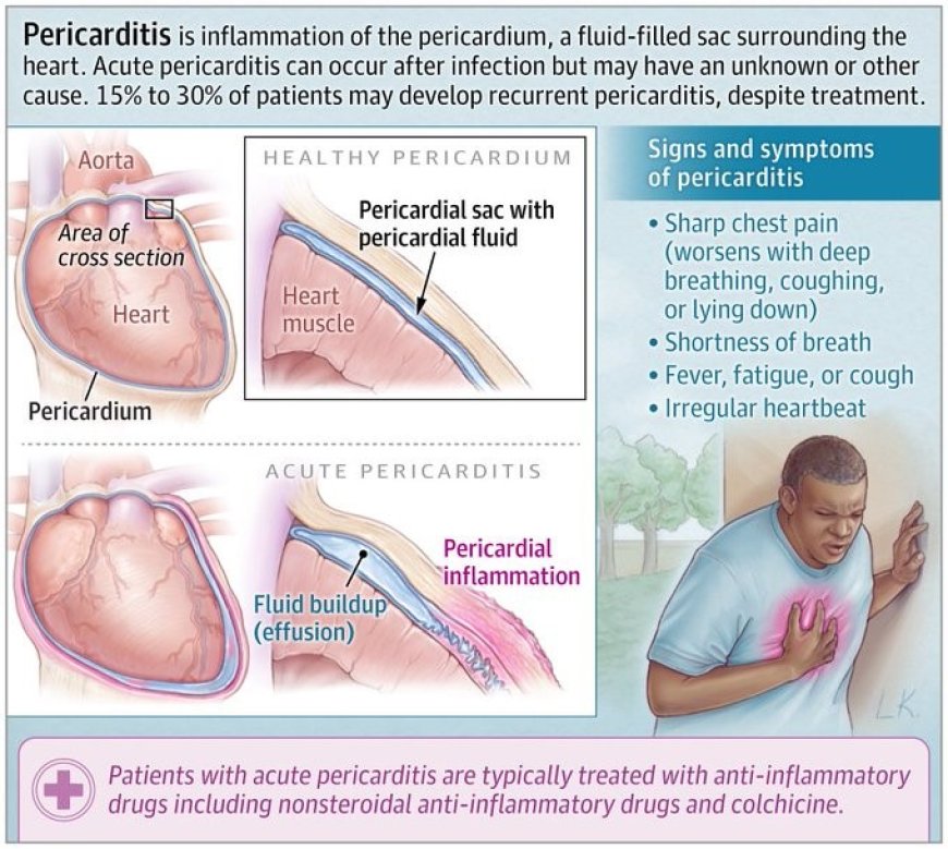 What Is Pericarditis?