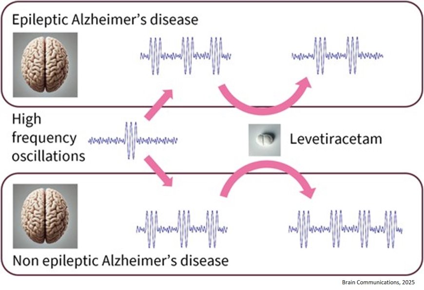 Brain rhythms can predict seizure risk of Alzheimer’s disease patients