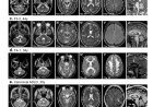 Gene ‘silencer’ in junk DNA prevents fatal neurological disease