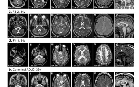 Gene ‘silencer’ in junk DNA prevents fatal neurological disease