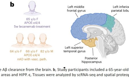 Microglia clears amyloid-β in Alzheimer’s immunized patients