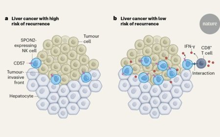 AI predicts hepatocellular carcinoma recurrence