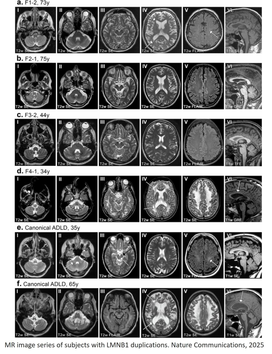 Gene ‘silencer’ in junk DNA prevents fatal neurological disease