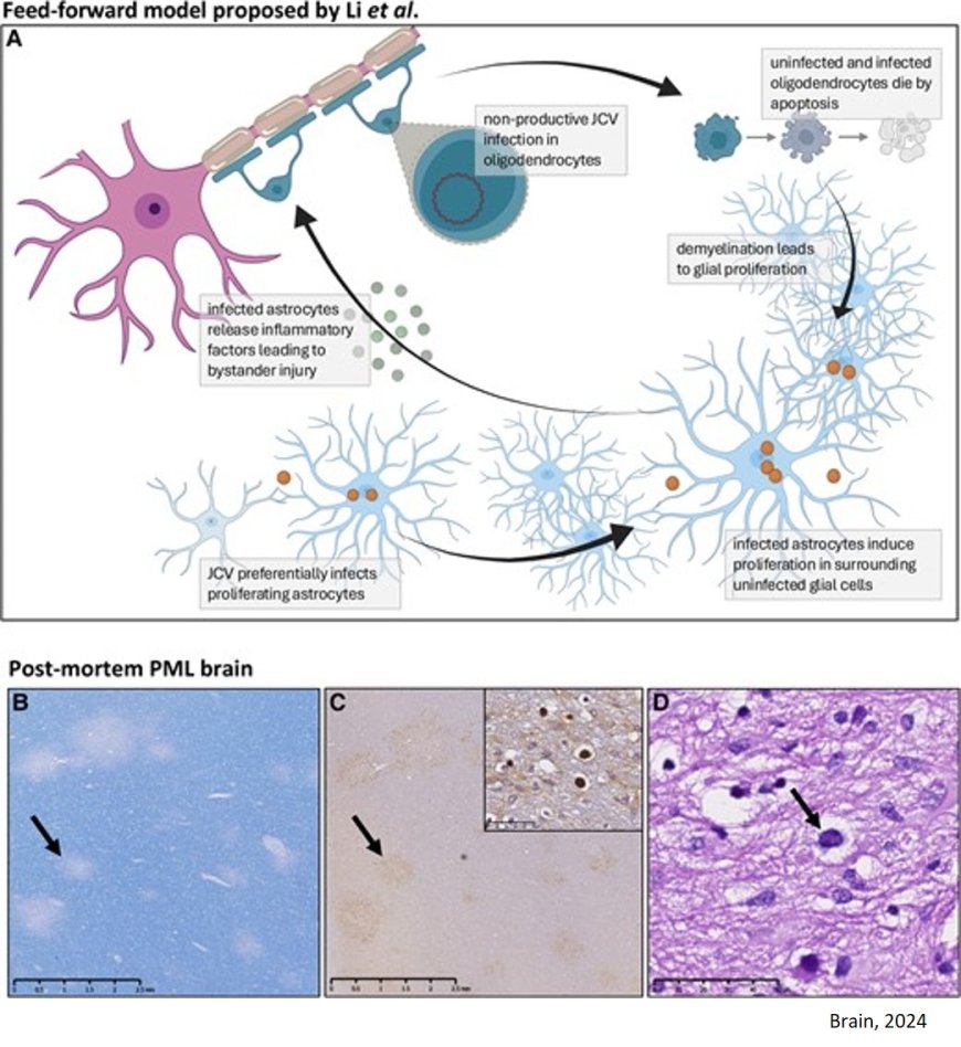 Bridging the gaps between JCV infection models and human disease