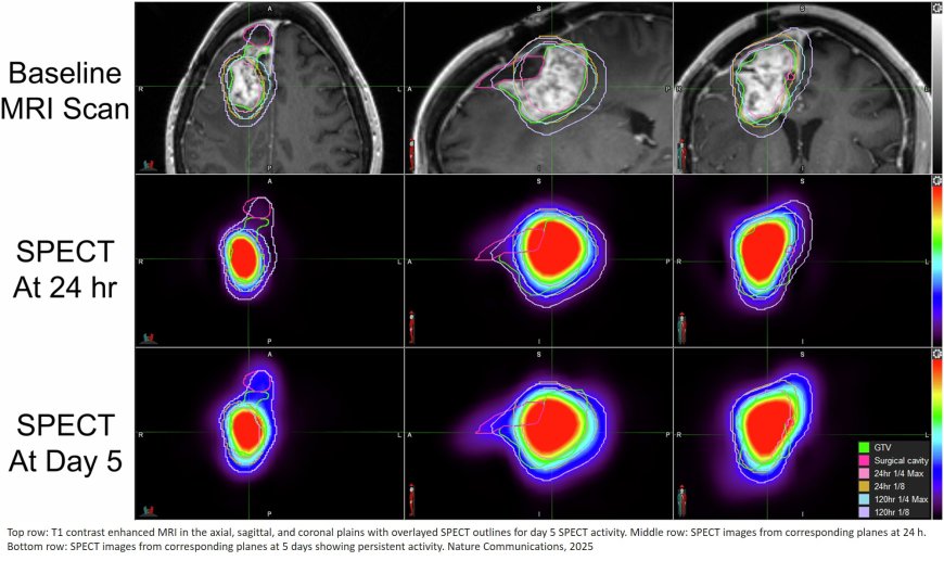 Glioblastoma patients survival time doubles in Phase I