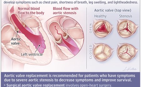 What Is Calcific Aortic Stenosis?