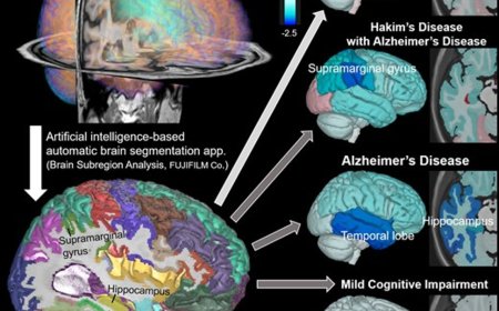 Regional brain volume changes in Hakim’s disease versus Alzheimer’s and mild cognitive impairment